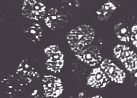 角膜上皮細胞剥離→バリア機能の低下→細菌の付着→感染症