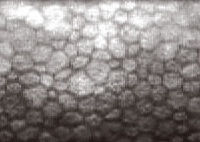 ダメージを受けた角膜内内皮細胞