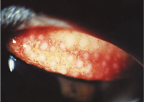 巨大乳頭結膜炎